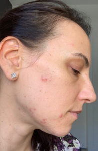 acne triggering eating disorders